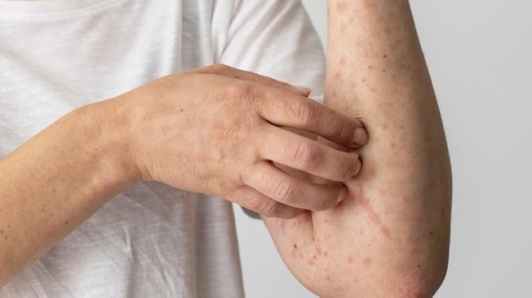 Минздрав рассказал, сколько в Беларуси выявлено случаев кори